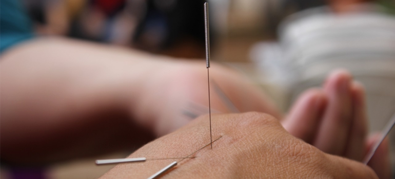 A close-up of a person’s hand having received acupuncture.