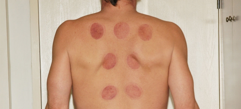 A close-up of an individual’s back, showcasing acupuncture markings.