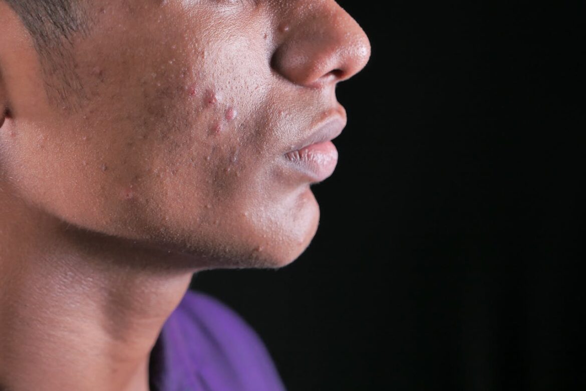 man with blemishes, one of the ways how does drug abuse affect skin health.