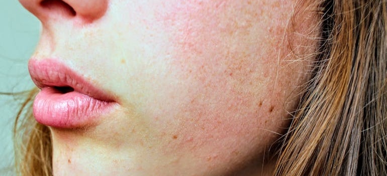 Close up picture of a woman's face who is struggling with drugs and skin sores.